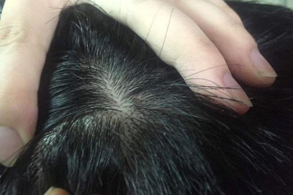 头皮有时候会有小的白色颗粒，这些东西是什么？