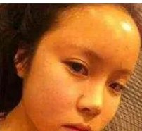 脂肪填充脸部有什么副作用?敢做吗?