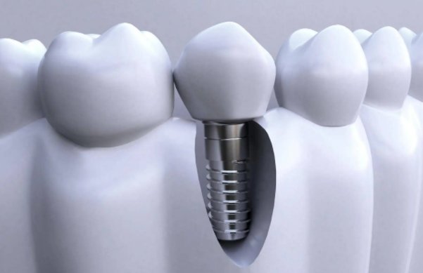 仅一成公众不支持种植牙价格管理！谁在阻拦低价种植牙？