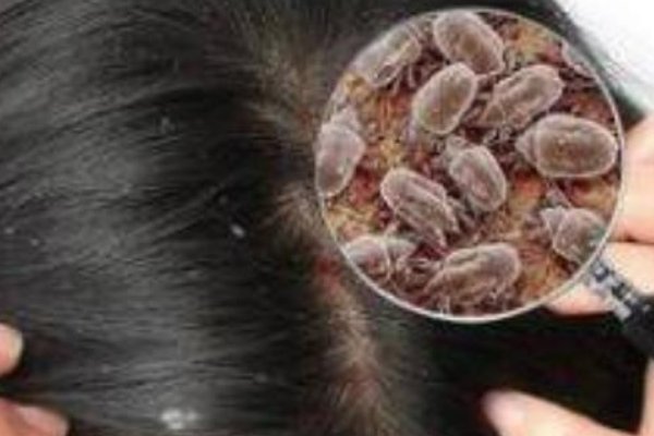 剪发虫是怎么引起的,怎么去除