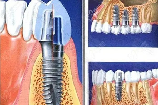国家医保局：仅一成公众不支持种植牙价格管理！这些人为何不支持？