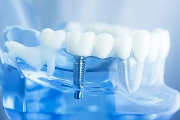 国家医保局：仅一成公众不支持种植牙价格管理！这些人为何不支持？