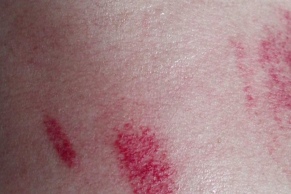 被吸草莓者什么感受 有人被吸草莓猝死了怎么回事