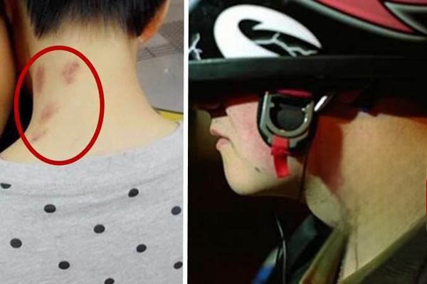 被吸草莓者什么感受 有人被吸草莓猝死了怎么回事