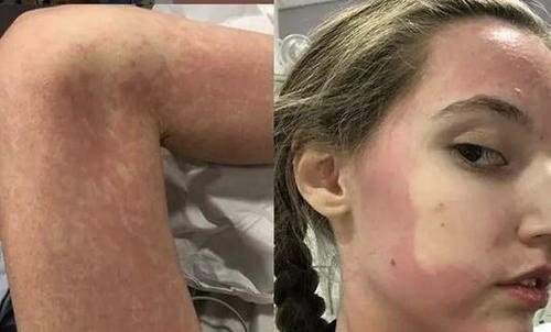 英国一女子对所有食物过敏，那她该怎样吃饭？