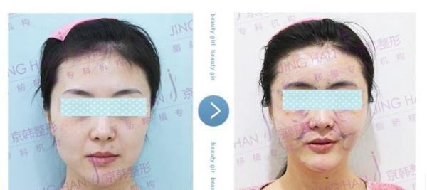 乔爱军医生:芭比术后面部实现完美蜕变,效果令人欣羡!
