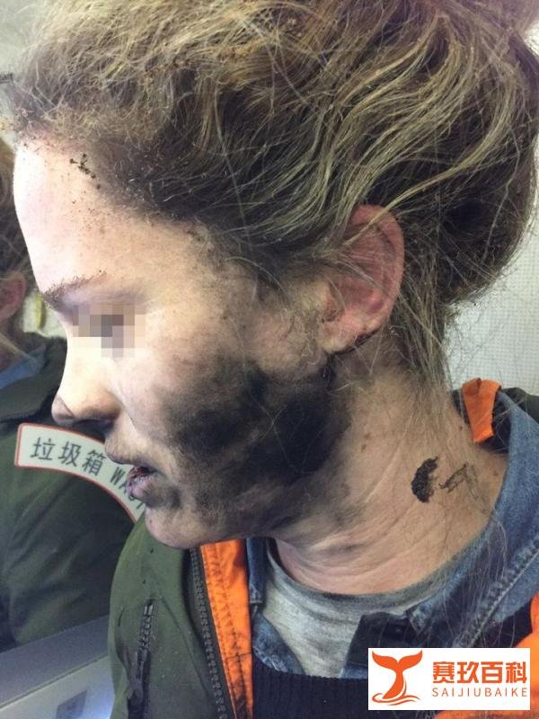 乘客在飞机上戴耳机睡觉，耳机突然爆炸半边脸都被烧伤了！