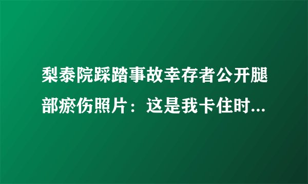 梨泰院踩踏事故幸存者公开腿部瘀伤照片：这是我卡住时承受的压力